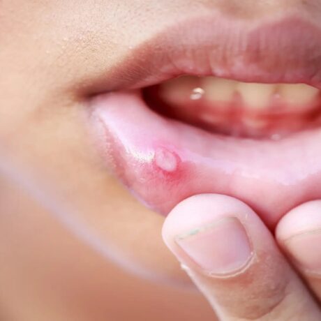 درمان آفت دهان: راهکارهای موثر برای درمان سریع آفت دهان