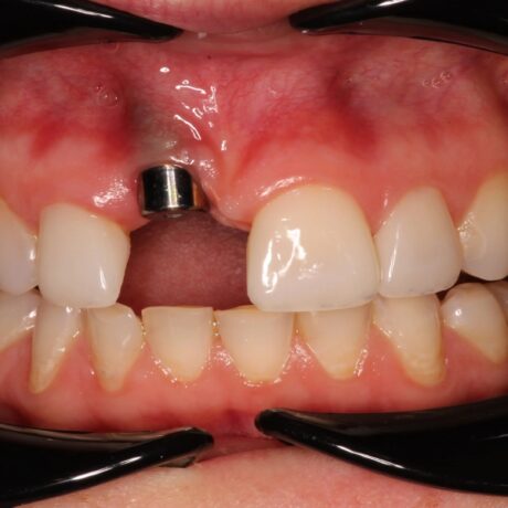 علائم پس زدن ایمپلنت دندان: راهنمای کامل پیشگیری تا درمان