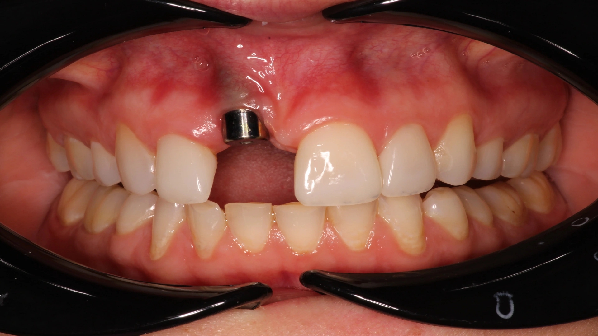 علائم پس زدن ایمپلنت دندان: راهنمای کامل پیشگیری تا درمان