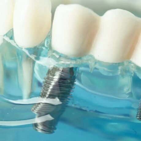 بهترین زمان ایمپلنت: چقدر بعد از کشیدن دندان باید ایمپلنت انجام داد؟