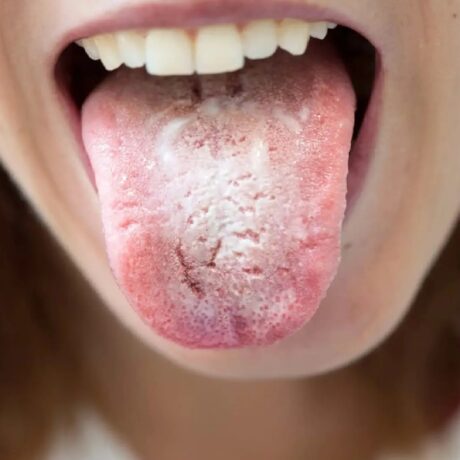 بررسی کامل برفک دندان در کودکان و بزرگسالان + روش‌های درمان