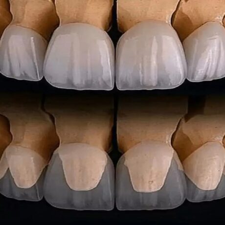 روکش زیرکونیا چیست: همه چیز درباره مزایا و معایب آن