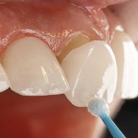 همه چیز درباره فرق لمینت با کامپوزیت دندان