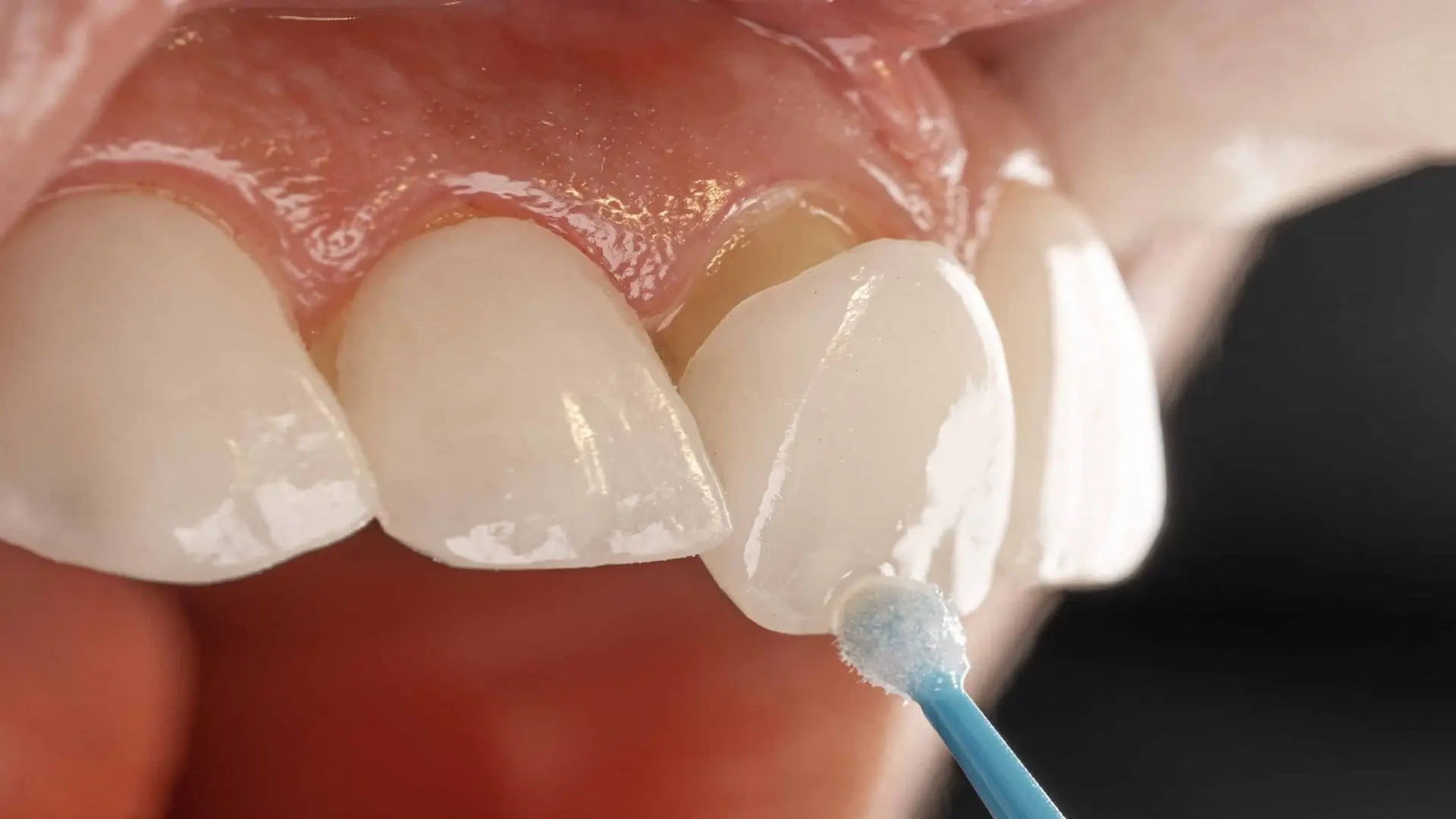 همه چیز درباره فرق لمینت با کامپوزیت دندان