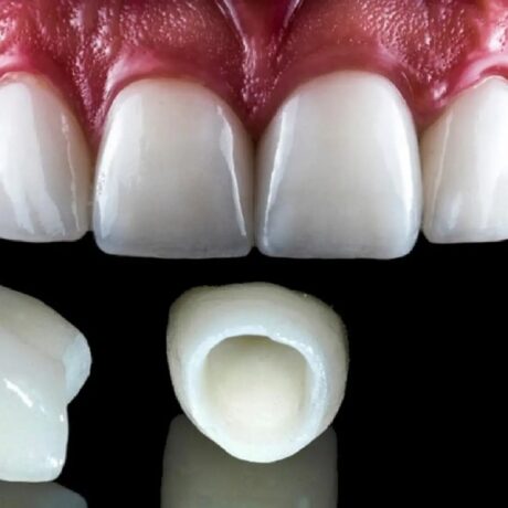 مراقبت بعد از روکش دندان چگونه است؟ + بررسی تمام نکاتی که باید بدانید!