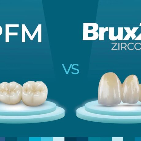 تفاوت روکش زیرکونیا با روکش pfm چیست؟