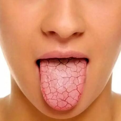 علت خشکی دهان چیست و چه بیماری‌هایی باعث خشکی دهان می‌شوند؟