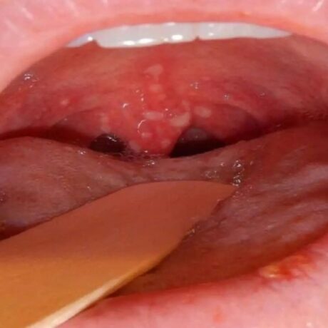 همه چیز درباره زگیل دهان: علائم، روش‌های پیشگیری و راه‌های درمان