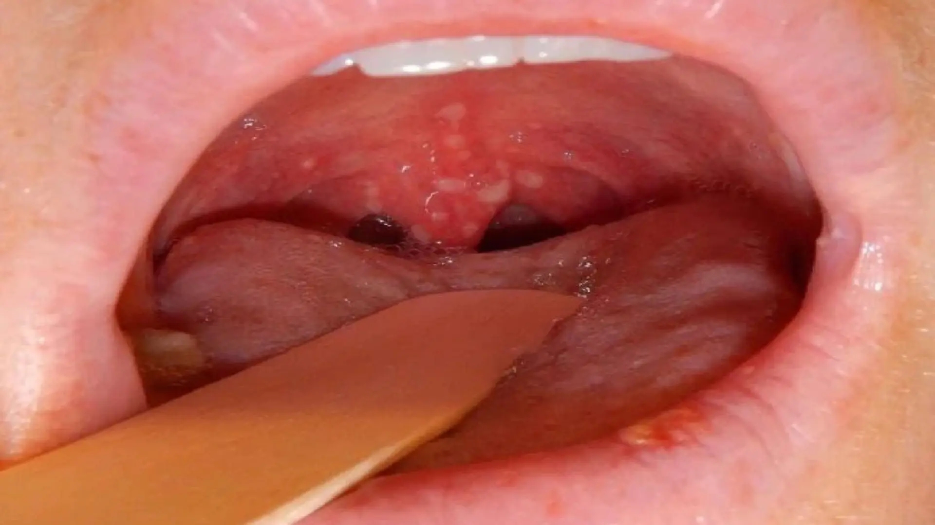 همه چیز درباره زگیل دهان: علائم، روش‌های پیشگیری و راه‌های درمان