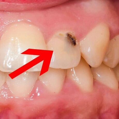 همه چیز درباره پوسیدگی دندان: علل بروز، راه‌های پیشگیری و روش‌های درمان