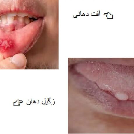تفاوت آفت دهان با زگیل دهانی: بررسی علائم، روش‌های پیشگیری و درمان