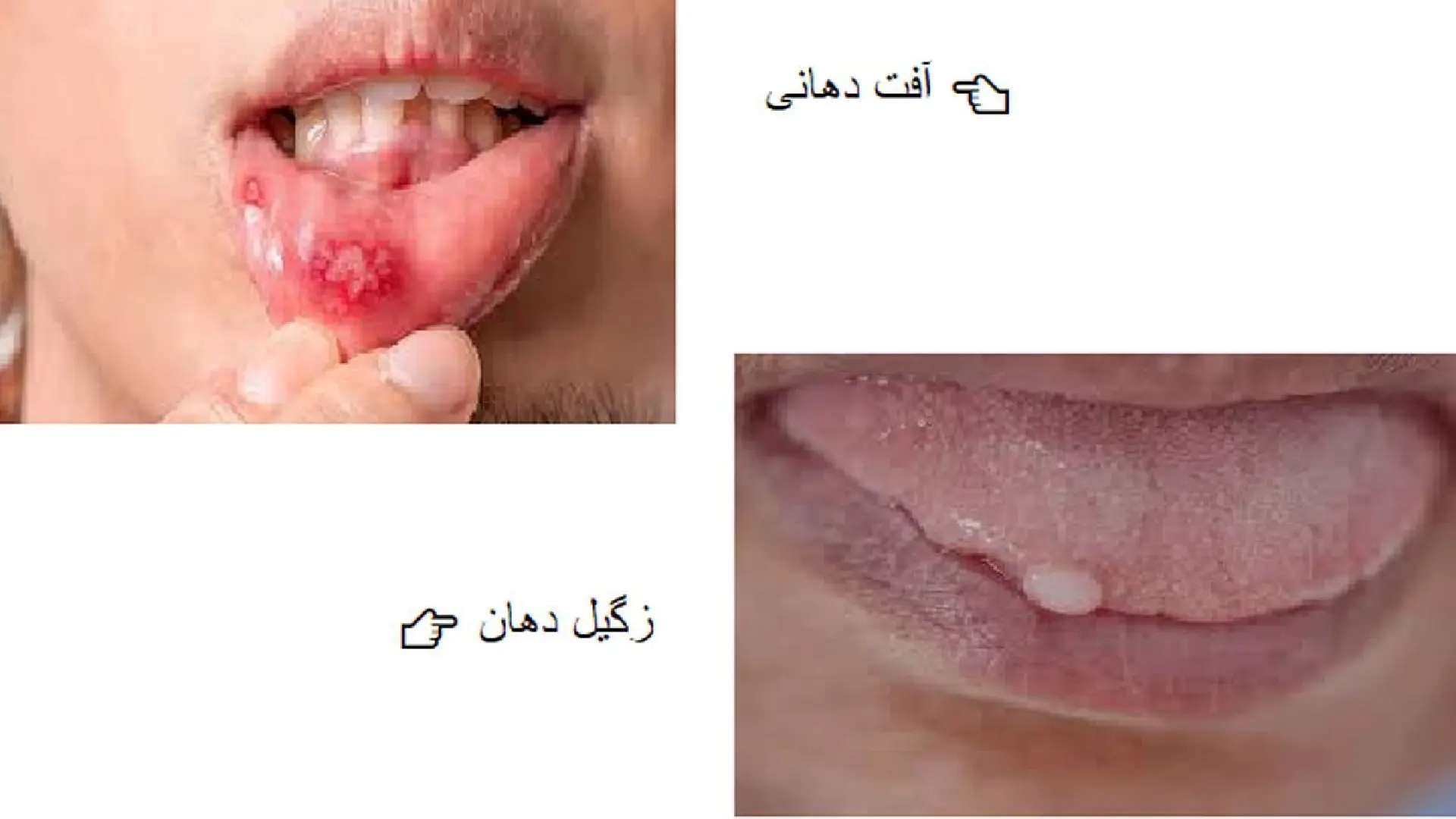 تفاوت آفت دهان با زگیل دهانی: بررسی علائم، روشهای پیشگیری و درمان