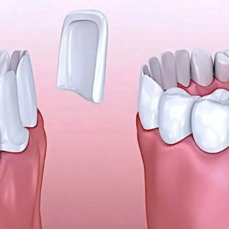 تفاوت روکش دندان زیرکونیا و لمینت دندان چیست؟