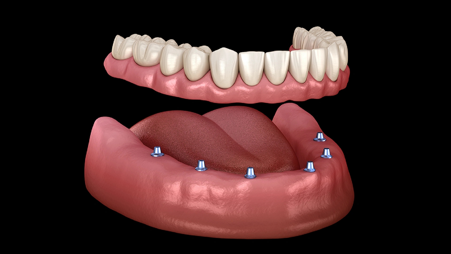 اوردنچر دندان چیست؟ راهنمای جامع از نحوه انجام تا مراقبت‎‌های بعد از آن