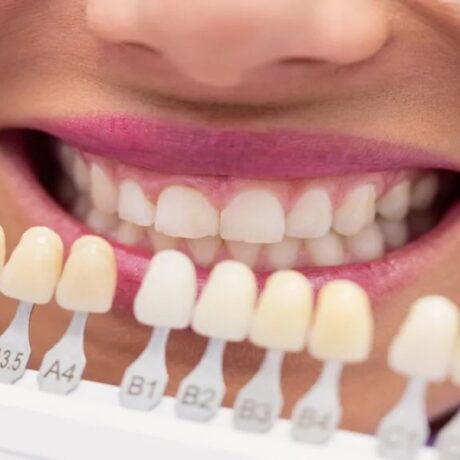 مراقبت‌های بعد از کامپوزیت دندان: راه‌های افزایش طول عمر کامپوزیت