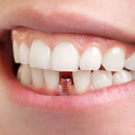 مراقبت های بعد از ایپملنت: تسریع بهبودی التهاب لثه بعد از ایمپلنت