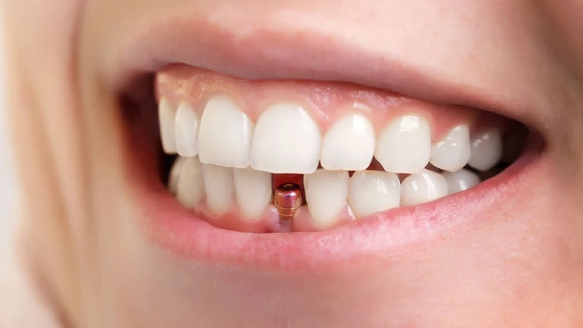 مراقبت های بعد از ایپملنت: تسریع بهبودی التهاب لثه بعد از ایمپلنت