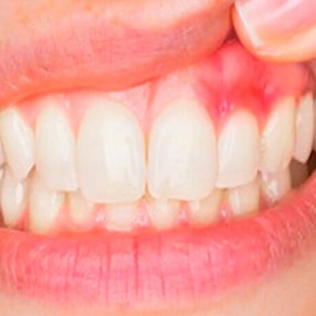 چه قرصی برای ورم لثه بخوریم: بهترین قرص ها برای ورم لثه