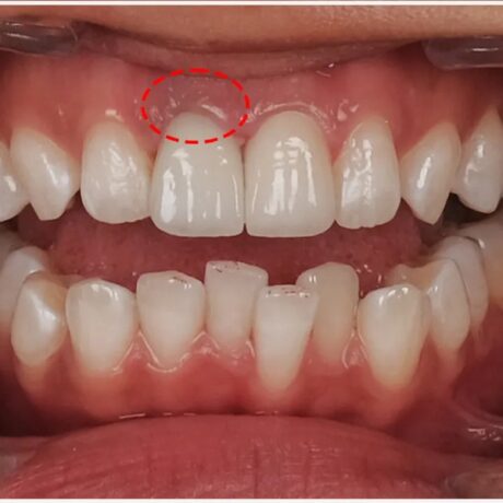 عوارض لمینت دندان چیست؟ روش‌های جلوگیری و مراقبت