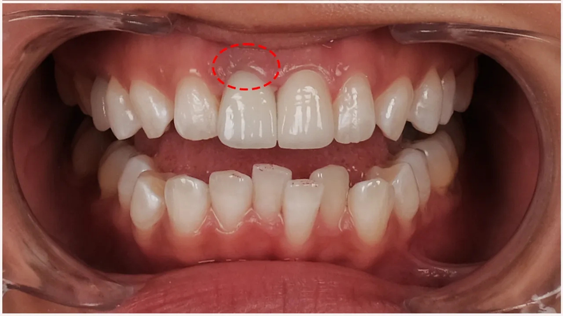عوارض لمینت دندان چیست؟ روشهای جلوگیری و مراقبت