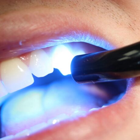 بوی بد دهان بعد از کامپوزیت دندان؛ علت‌ها و راهکارها